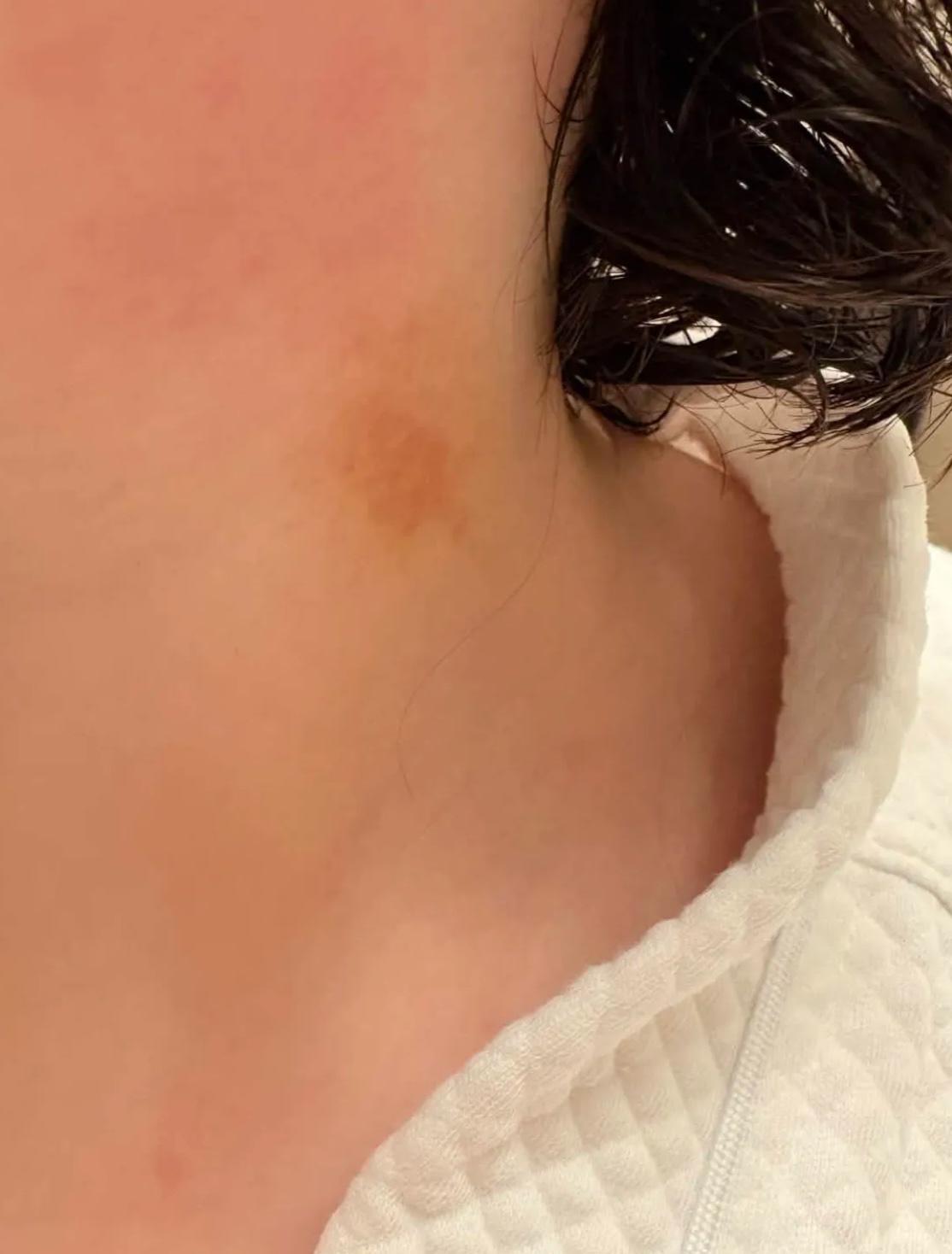 Заживающий синяк